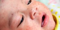 افزایش ۳ برابری مبتلایان به سرخک در جهان