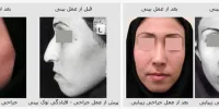 جراحی زیبایی بینی بدون درد و کبودی