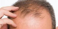 چگونه ریزش‌ مو را متوقف کنیم