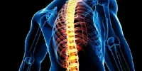 اسکولیوز؛ رایج‌ترین اختلال ستون فقرات