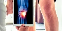 8 عامل ابتلا به پوکی استخوان را بشناسید