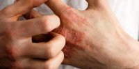 بلاهایی که استرس بر سر پوست شما می آورد