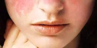 نکاتی مهم درباره یک بیماری هزارچهره که ۹۰ درصد مبتلایانش زنان هستند