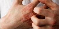 نشانه‌های ضعف سیستم ایمنی بدن