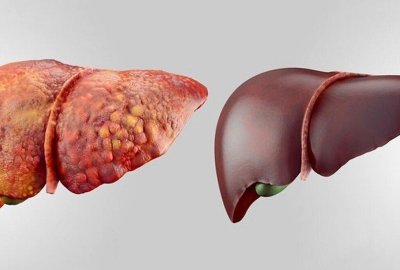 شایع‌ترین بیماری کبدی جهان چیست؟